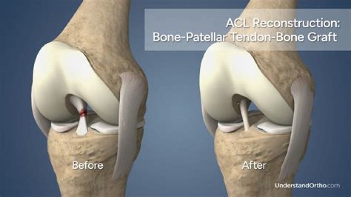 Can torn ACL repair itself?