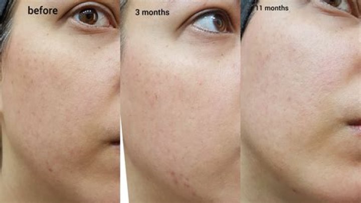 Can tretinoin cream help cellulite?