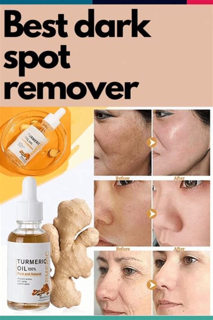 Can turmeric and curd remove dark spots?