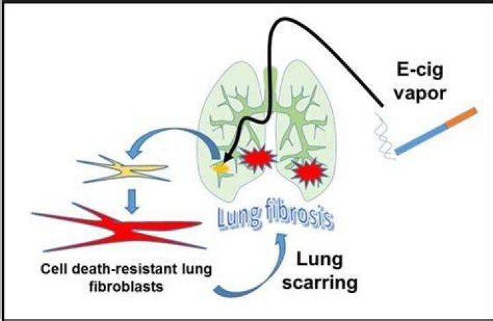 Can vaping scar your lungs?