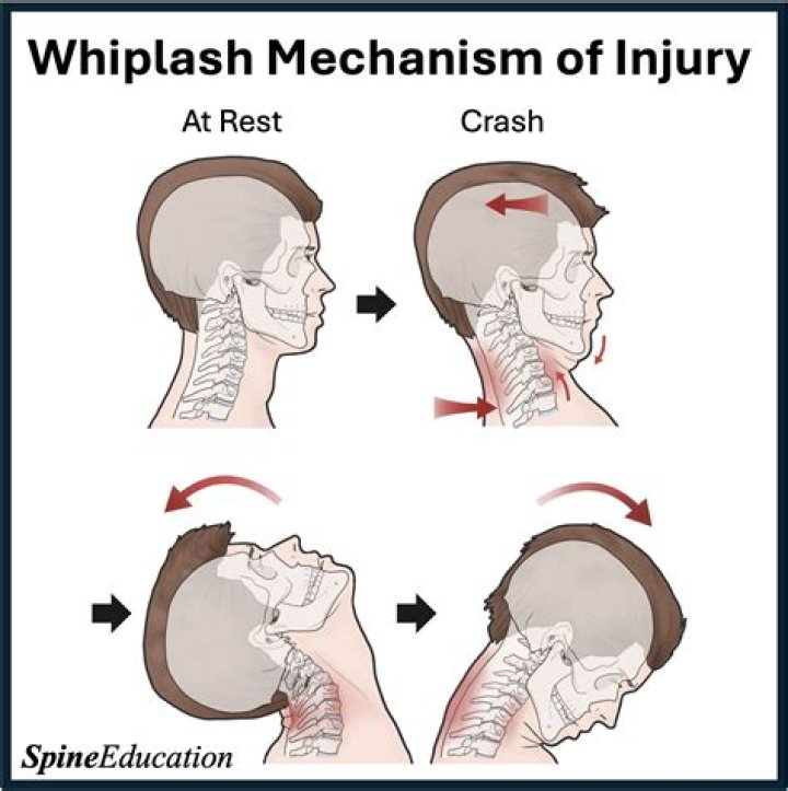 Can whiplash be serious?