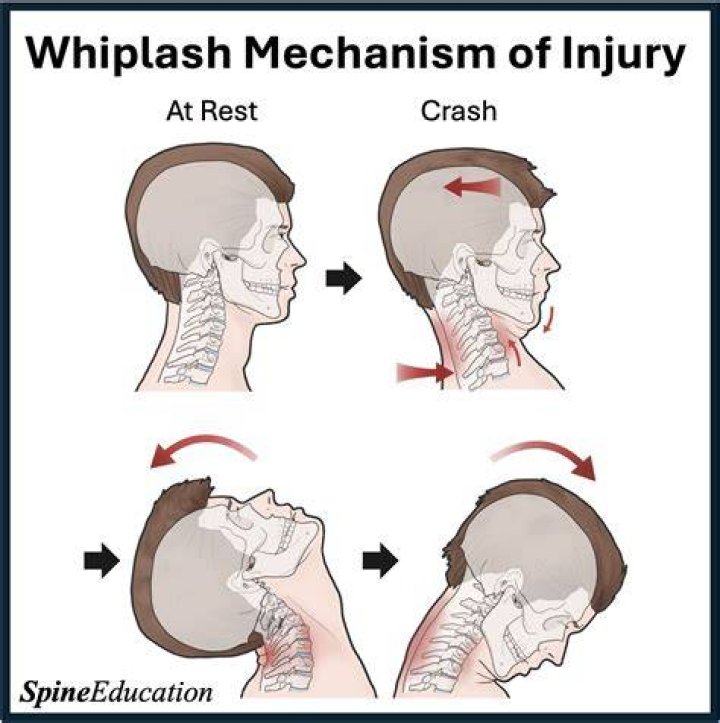 Can whiplash occur months after an accident?