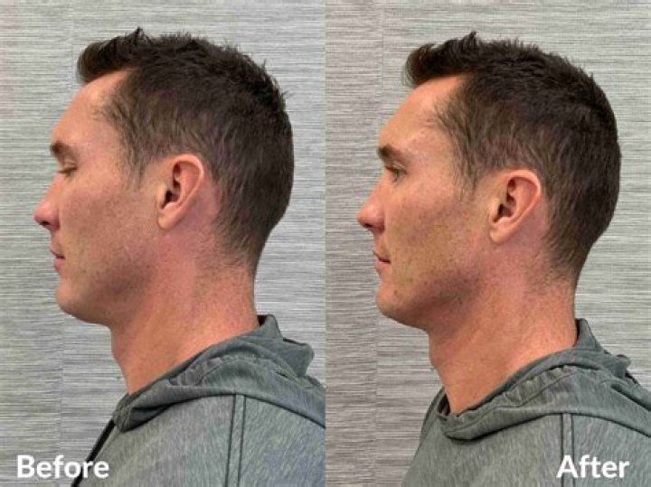 Can you Coolsculpt your jawline?