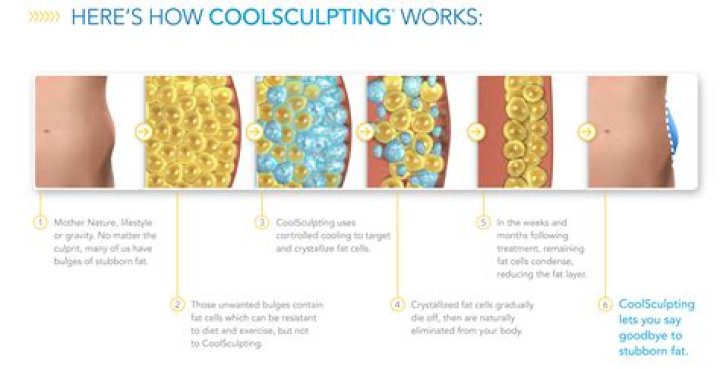 Can you do CoolSculpting twice?