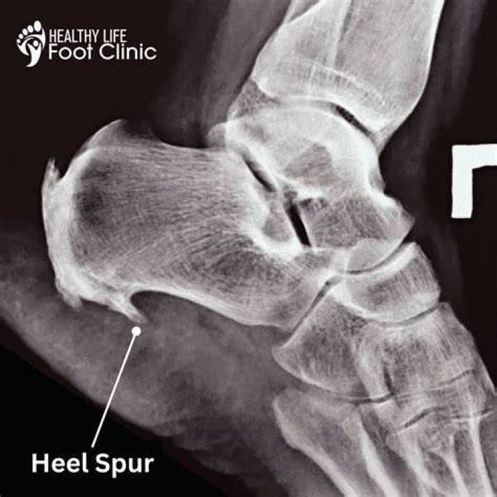 Can you feel a heel spur?