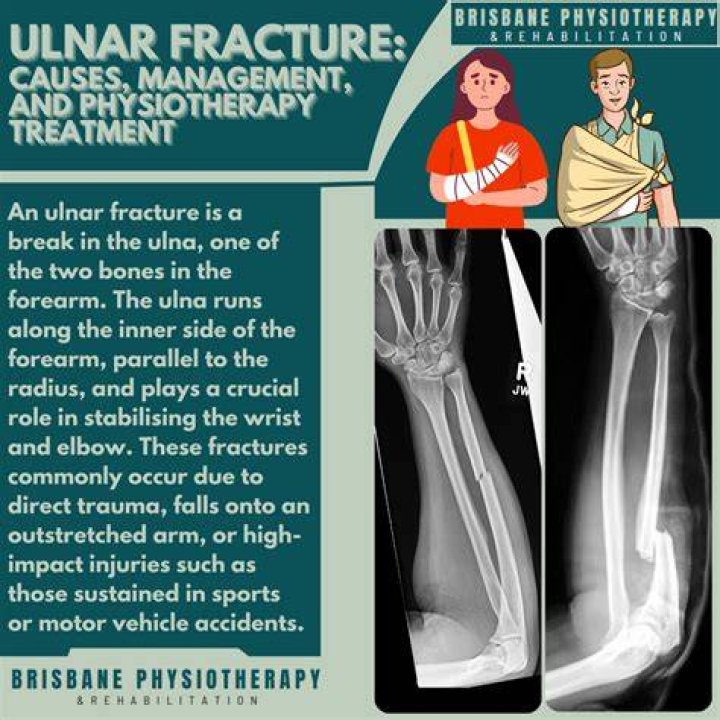 Can you fracture your wrist bowling?