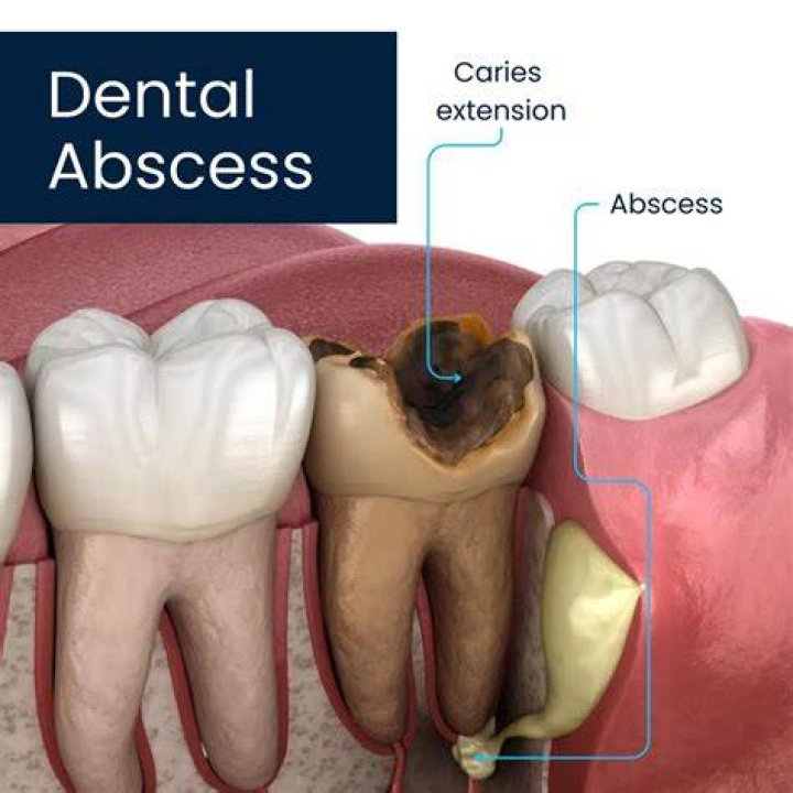 Can you get an abscess under a crown?