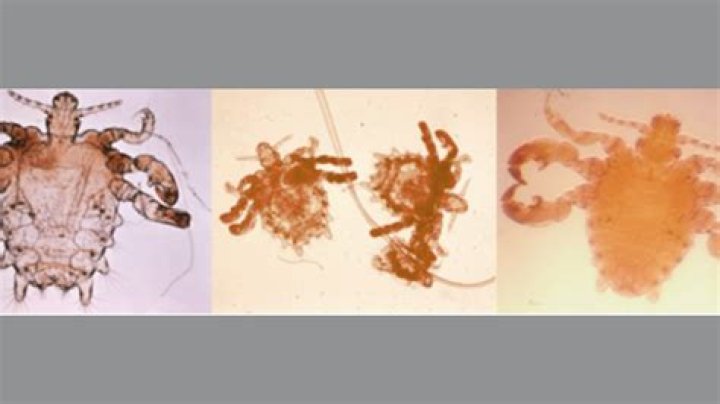 Can you get crabs if you have no hair?