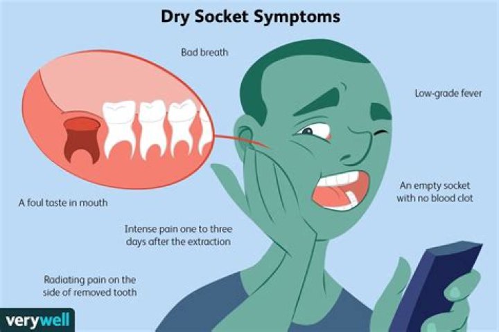 Can you get dry socket after 7 days?