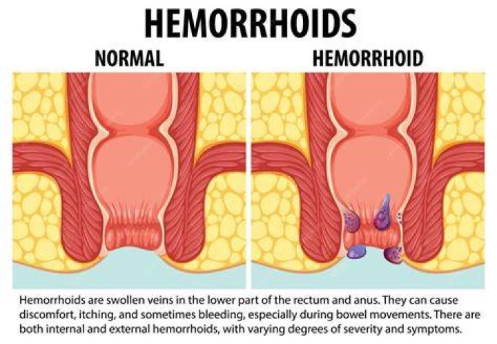 Can you have a hemorrhoid for years?