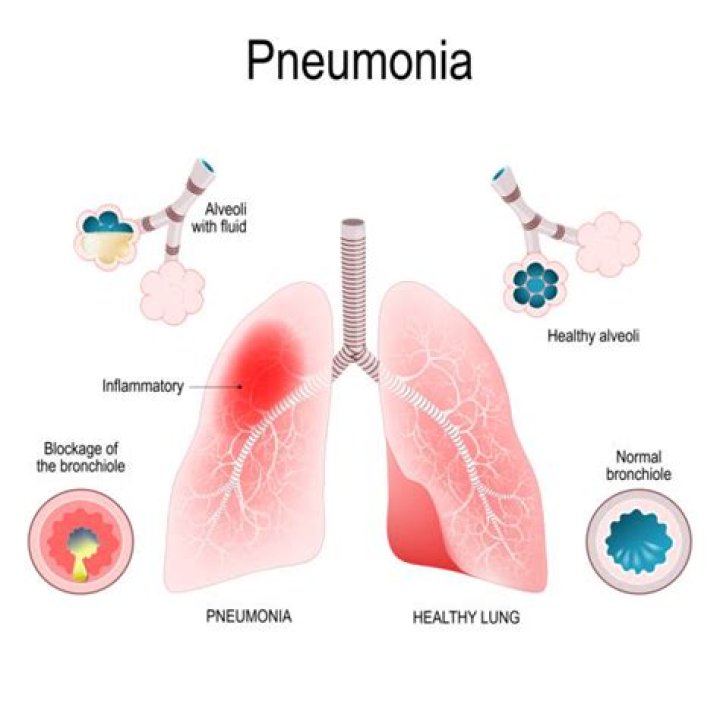Can you have pneumonia and not know it?