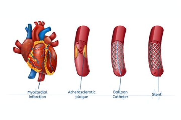 Can you live a long life with heart stents?