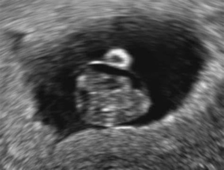 Can you miscarry at 7 weeks?