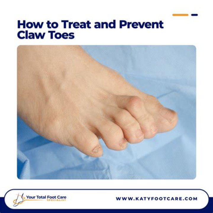Can you reverse claw toes?