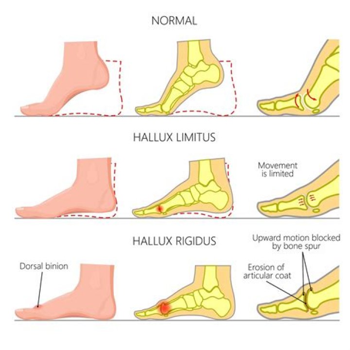 Can you reverse hallux rigidus?