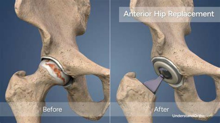 Can you ride in a car after hip surgery?