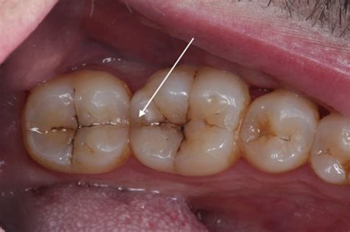 Can you smell a rotten tooth?