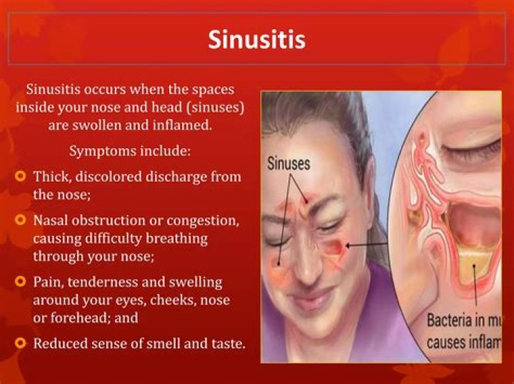 Can you smell and taste a sinus infection?