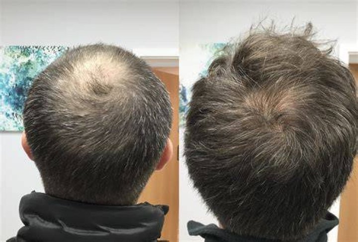 Can you stop balding?
