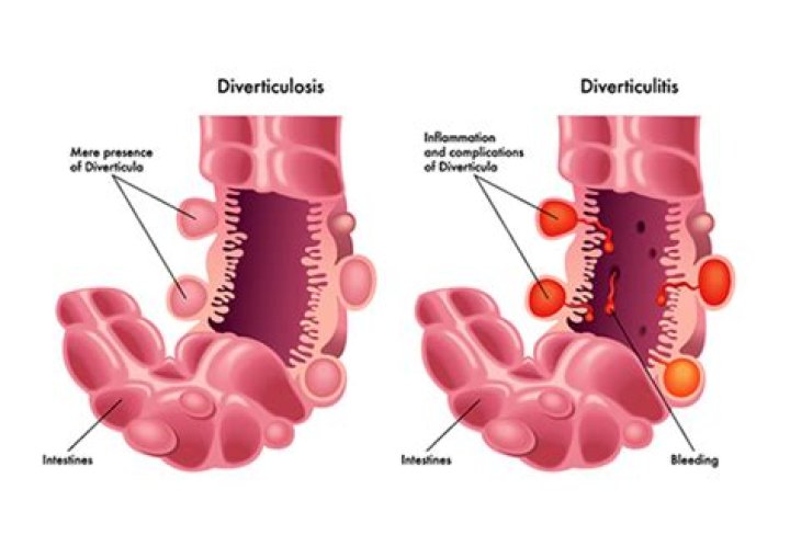 Can you suddenly develop diverticulitis?