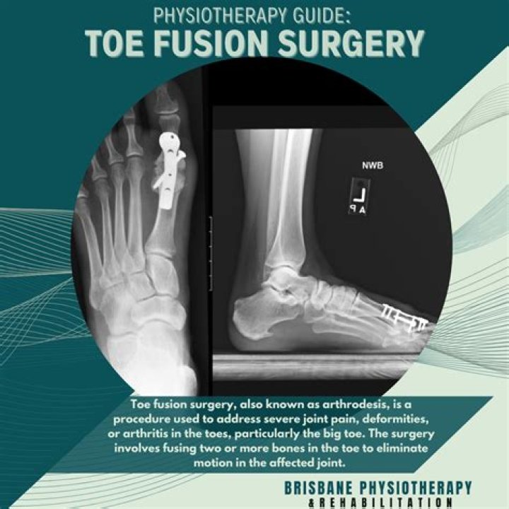 Can you walk after big toe Fusion?