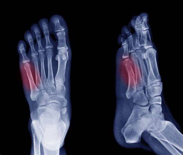 Can you walk with a broken metatarsal?