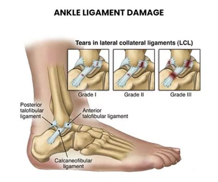 Can you walk with a torn ligament?