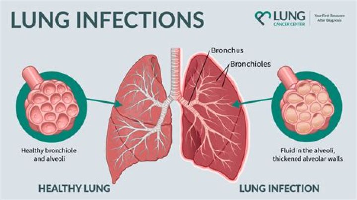 Could I have a lung infection?