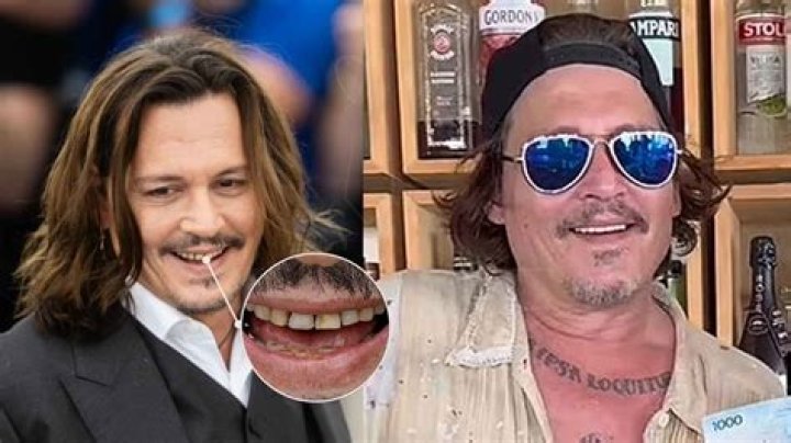 Did Finlay get new teeth?