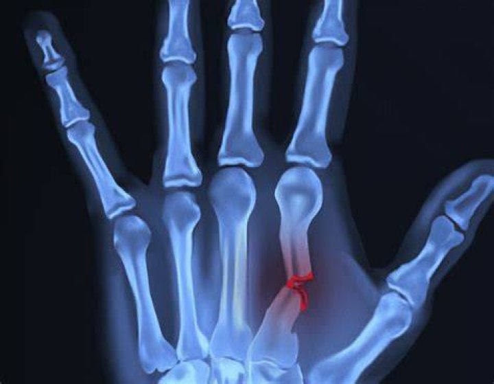 Did I break a bone in my hand?