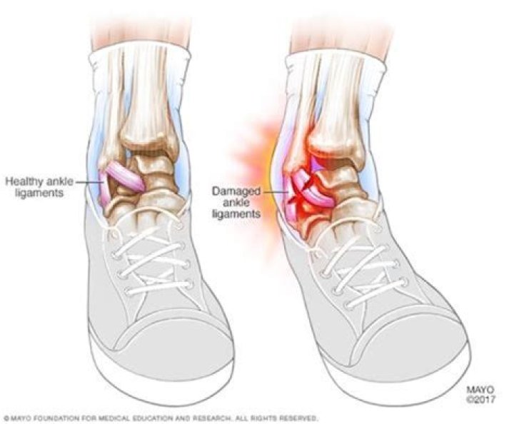 Did I sprain my ankle or tear a ligament?