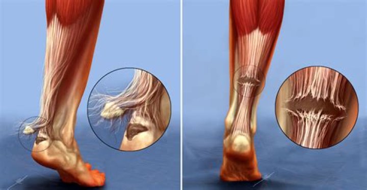 Did I tear a tendon in my ankle?