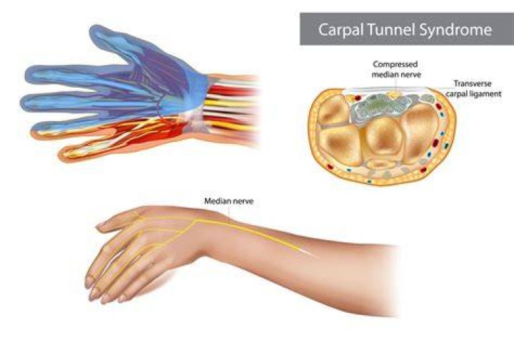 Do bowlers get carpal tunnel?