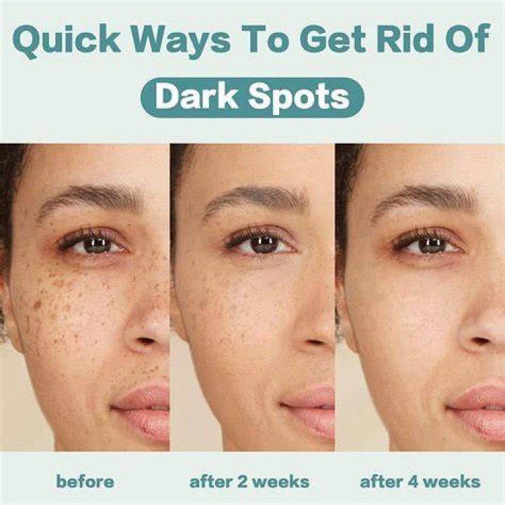 Do dark spots go away?