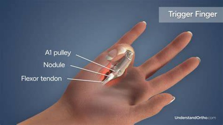 Do golfers get trigger finger?