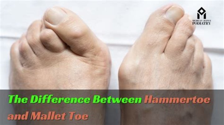 Do hammer toes get worse over time?