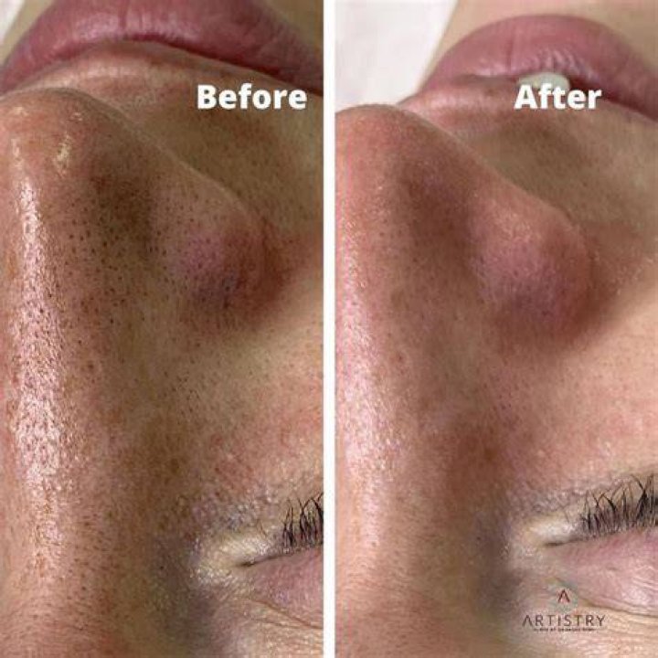 Do pores open after exercise?