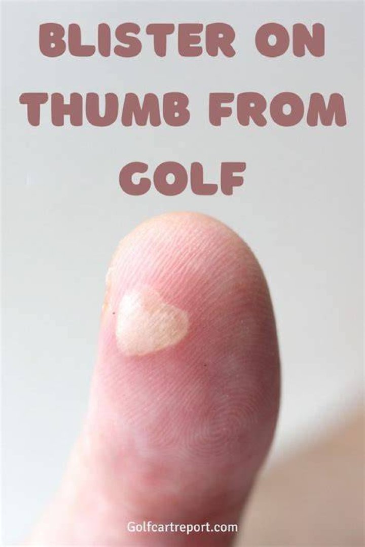 Do pro golfers get blisters?
