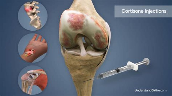 Do they numb you before a cortisone shots?