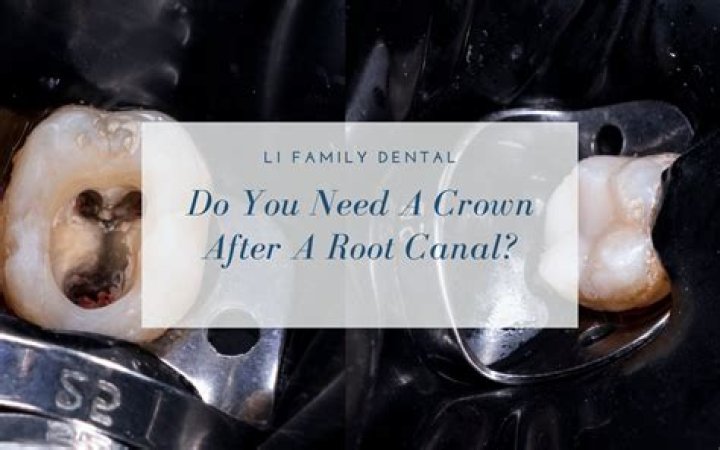 Do they numb you for a crown after a root canal?