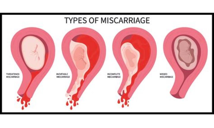 Do you bleed a lot with an early miscarriage?