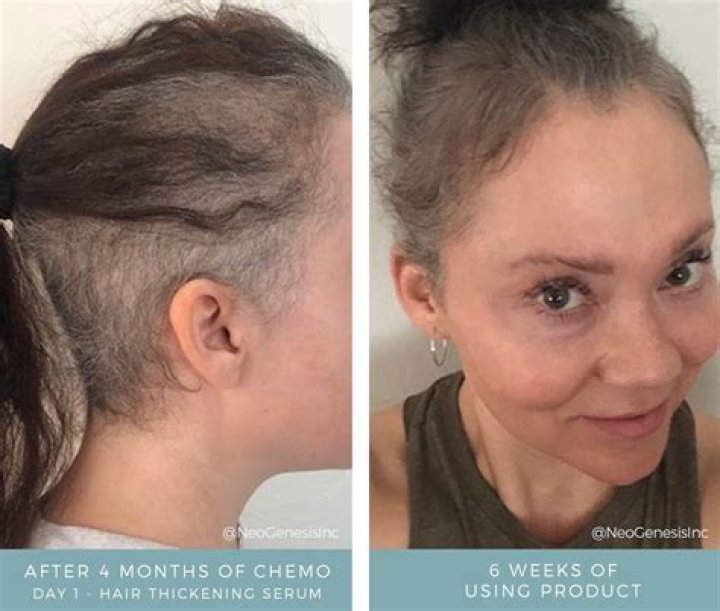 Do you lose your hair with rituximab?