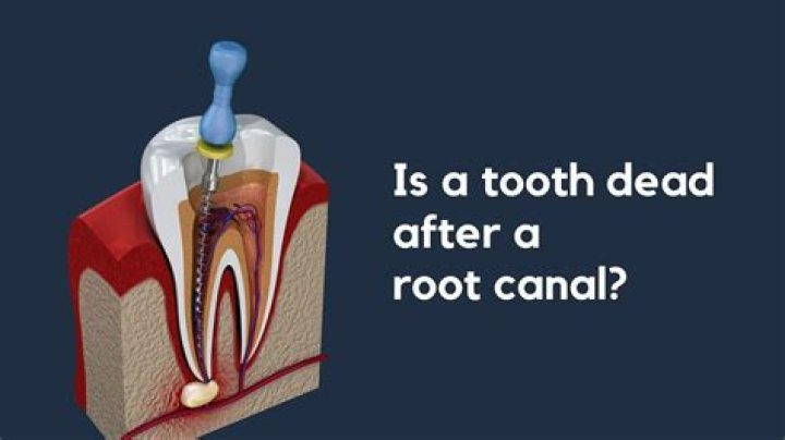 Do you need a root canal if you pull the tooth?
