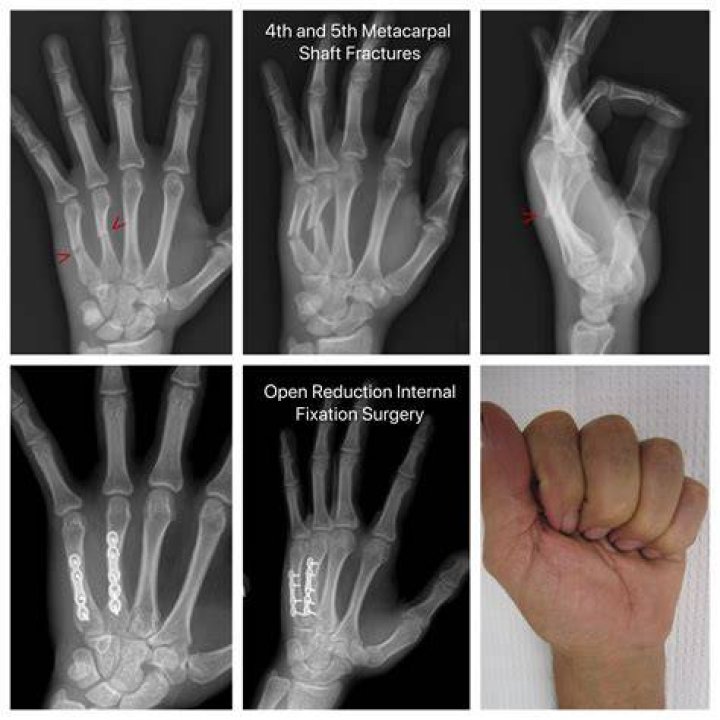 Does 5th metacarpal fracture need surgery?