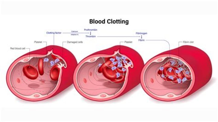 Does alcohol prevent blood clots?
