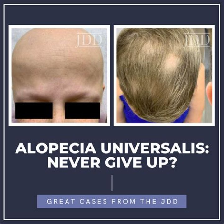 Does alopecia ever go away?