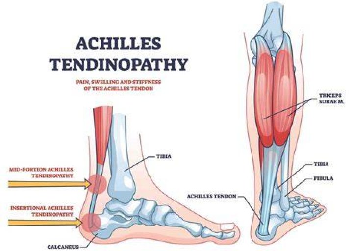 Does an MRI show tendonitis?