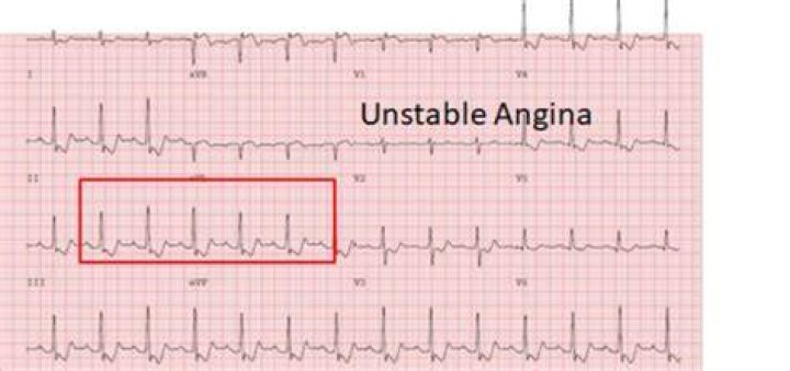Does angina show on ECG?