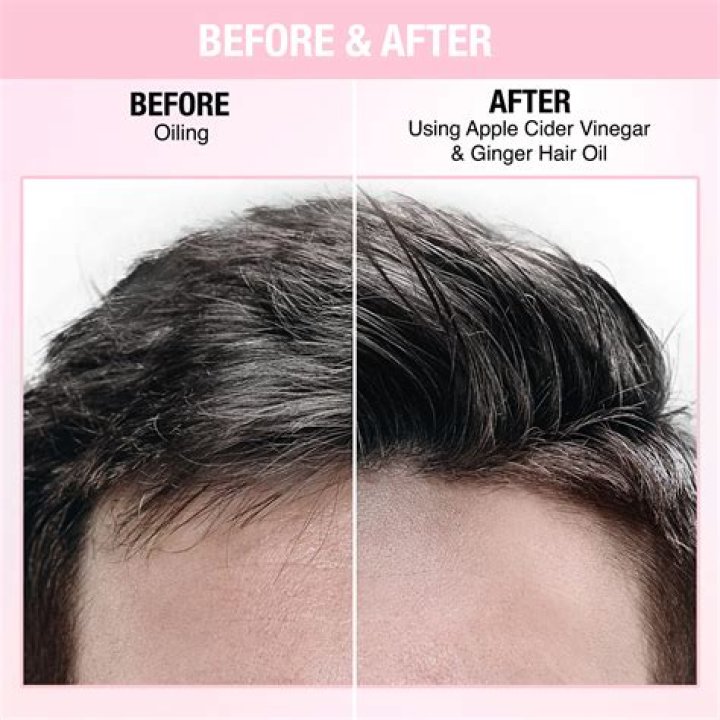 Does apple cider vinegar stop hair shedding?