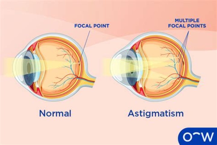 Does astigmatism affect golf swing?